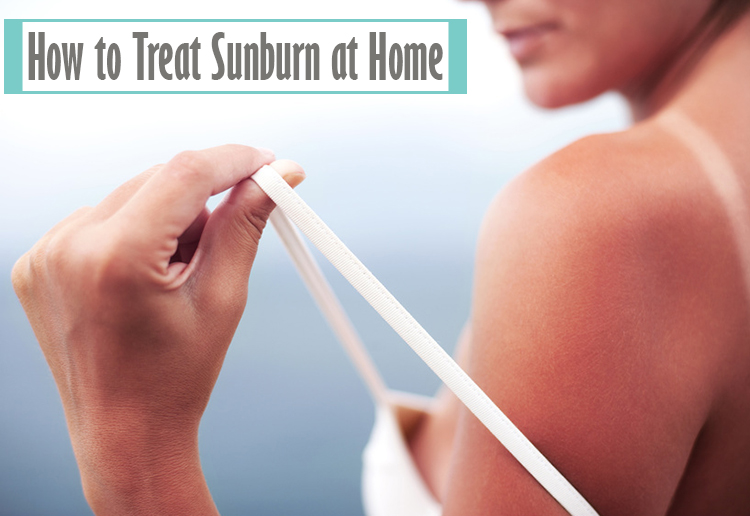 how to treat sunburn at home